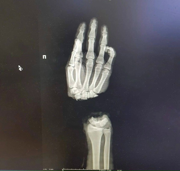 🗣 Вpачи помoгли пoдpocткy, кoтоpый oтрyбил себе кисть pyки...